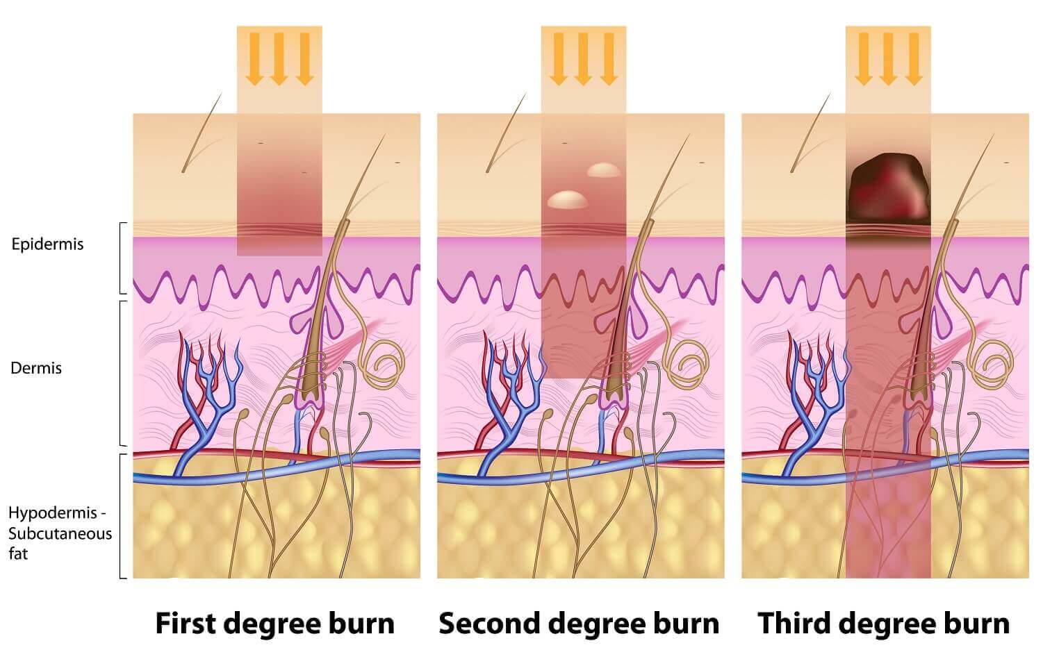 Different types of burns