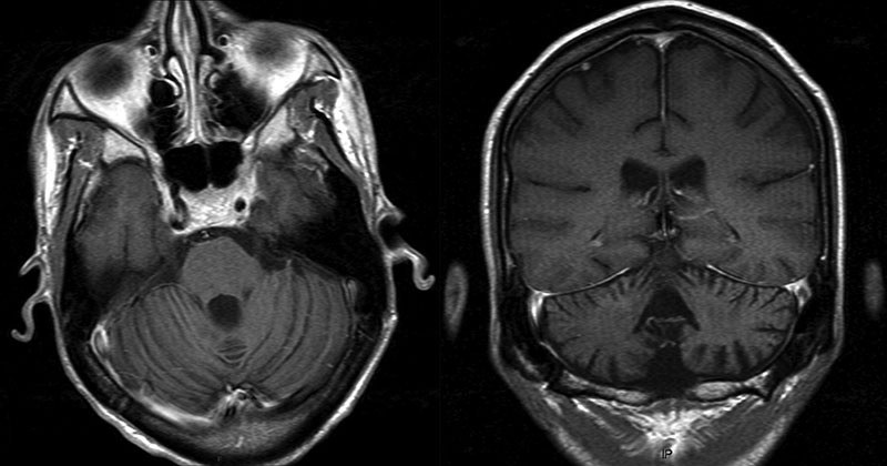 Brain with cerebellar atrophy