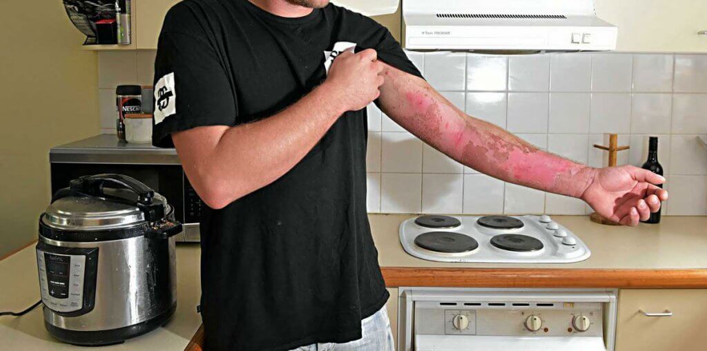pressure cooker injuries