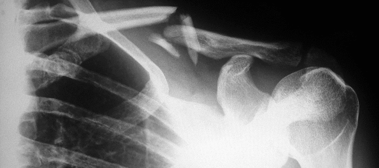 X-Ray of broken bone