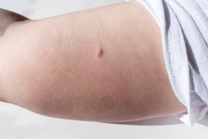 A closeup of a woman's arm following a Nexplanon implantation.