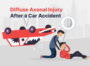 Diffuse Axonal Injury After a California Car Accident