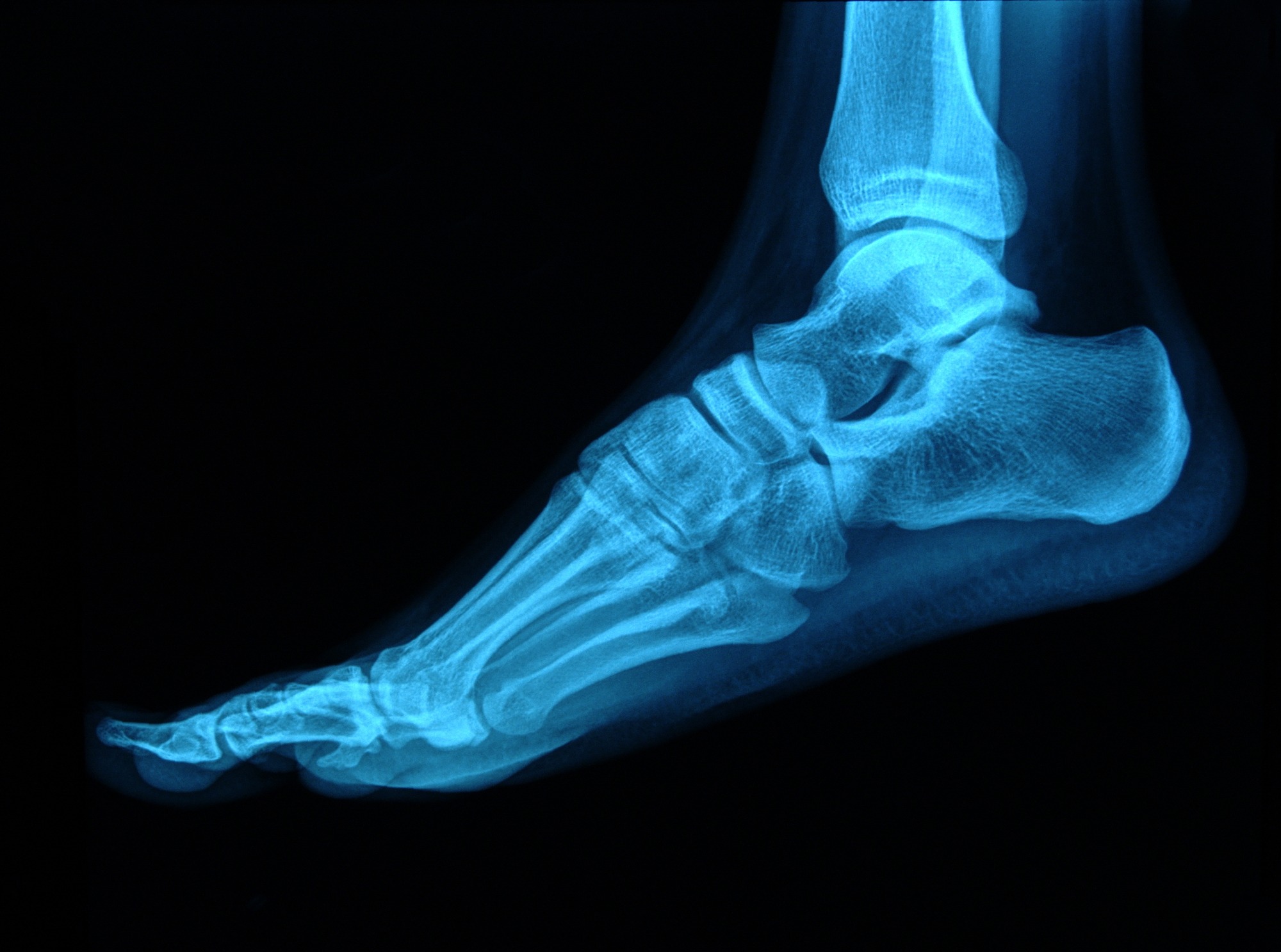 X-ray of a foot from the side