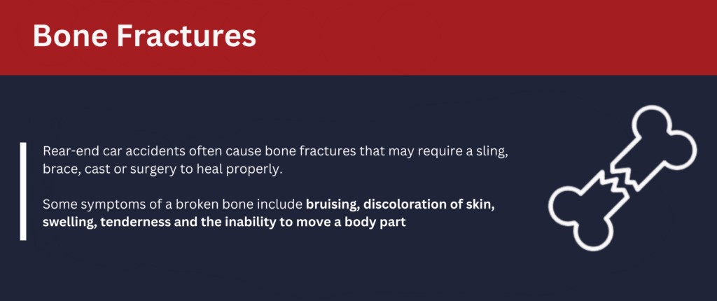 Rear-end car accidents often cause bone fractures that may require a sling, brace, cast or surgery to heal properly.
