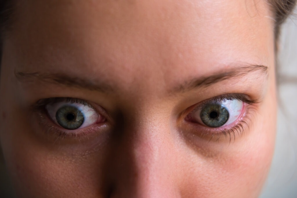 A woman with thyroid eye disease, her blue eyes open wide.