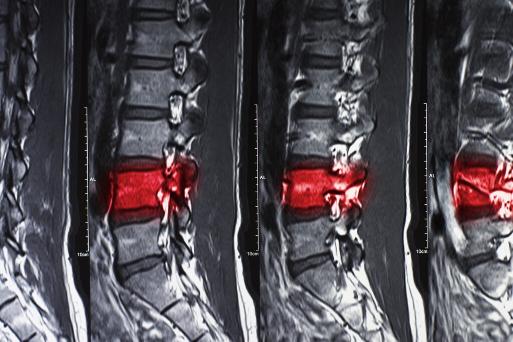 X ray of a spinal cord injury.