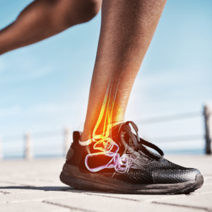 Exactech Ankle Replacement Lawsuit