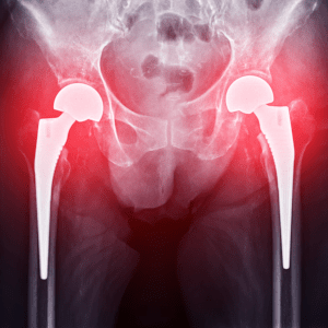 Zimmer Biomet CPT Hip System Lawsuit