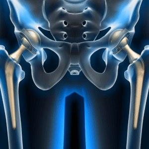 Zimmer Biomet CPT Hip System Lawsuit